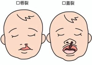 カカロニ栗谷と口唇口蓋裂